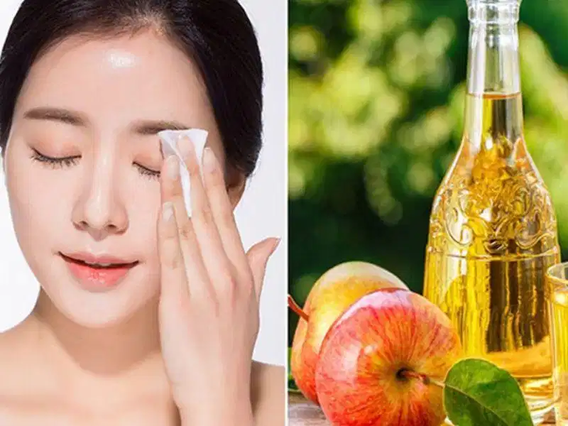 Cân bằng da sẹo mụn bằng giấm táo Giấm táo pha loãng hỗ trợ cân bằng độ pH bề mặt và làm sạch tế bào sừng già cỗi