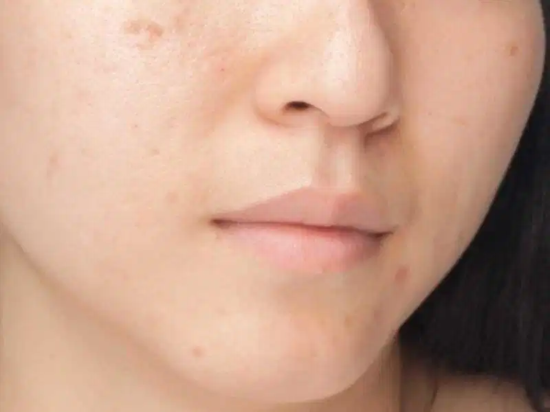 Khả năng tự hồi phục của mô sẹo theo thời gian Vết thâm sẹo có thể mờ dần theo chu kỳ thay da sinh học nhưng sẹo rỗ cần giải pháp can thiệp chuyên sâu