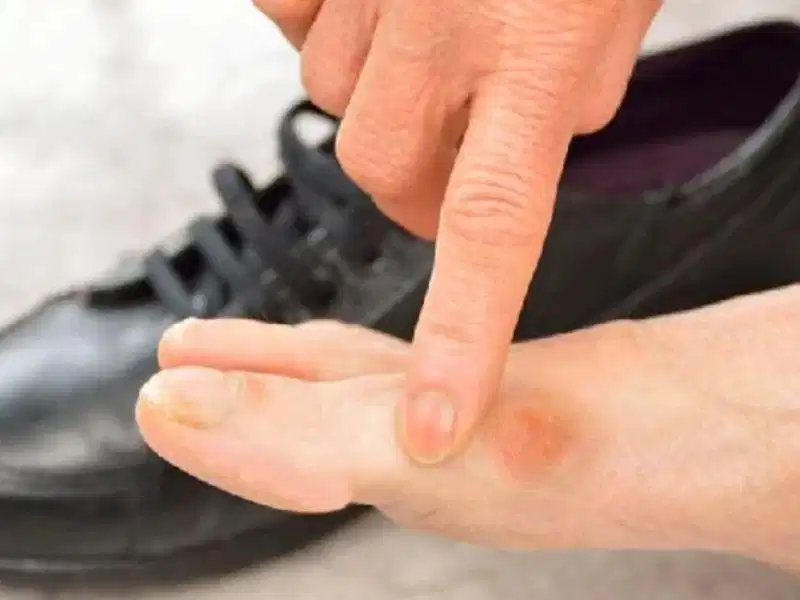 Chân sẽ ra sao nếu mang giày quá chật? Chân sẽ ra sao nếu mang giày quá chật?