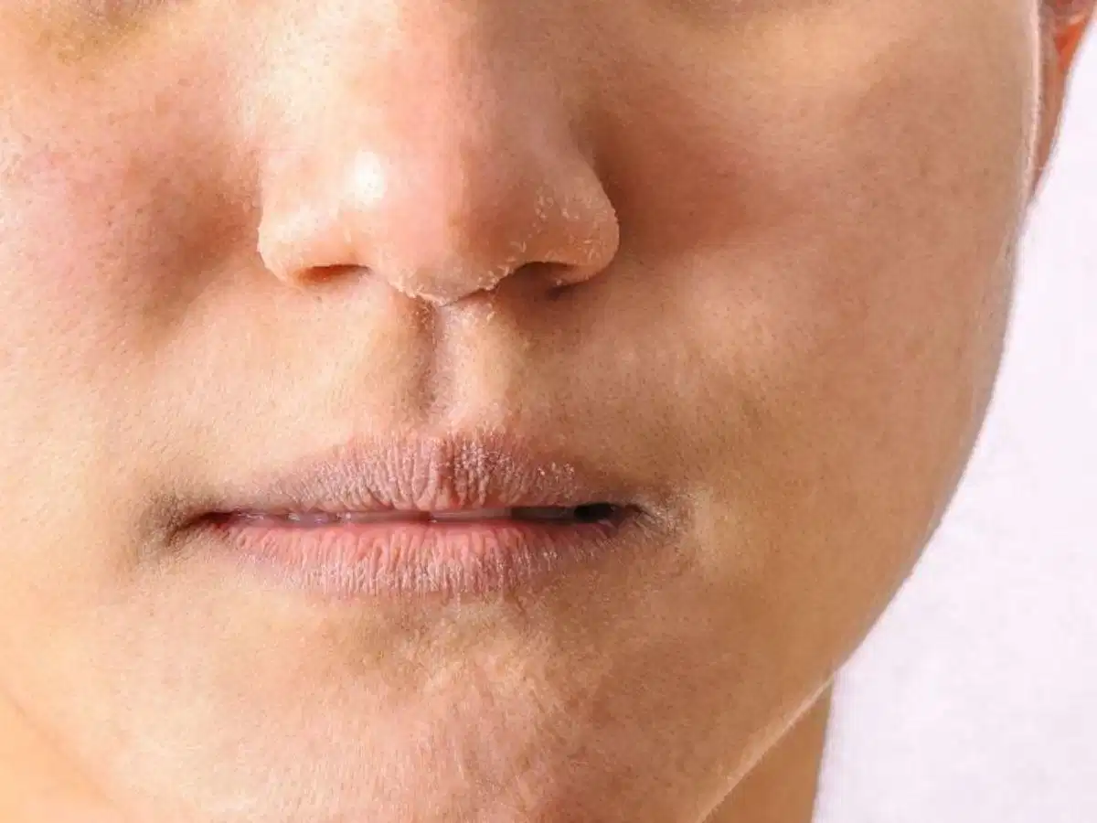Da chưa được cấp ẩm phù hợp dễ khiến lớp nền bong và không đều