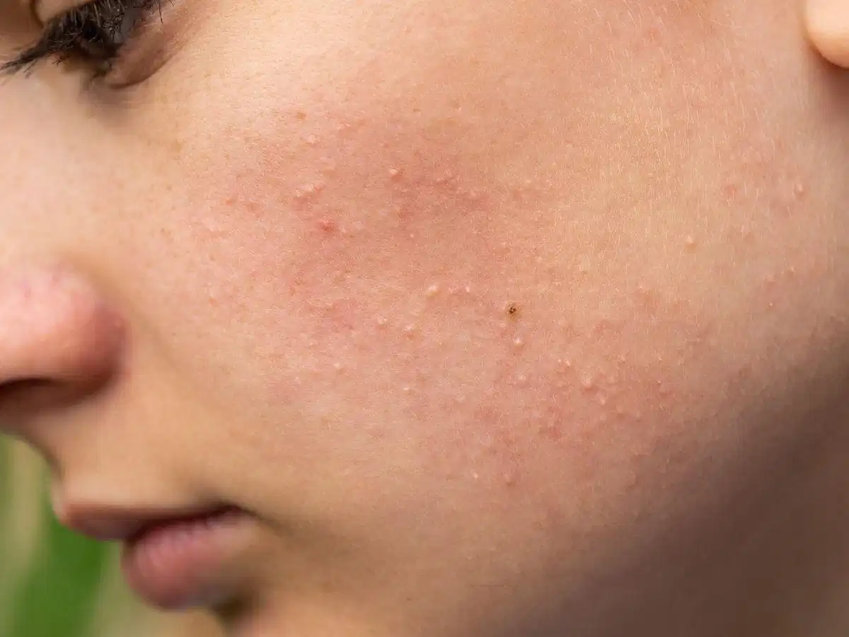 Da mụn cần chú ý công thức và vệ sinh dụng cụ trang điểm Da mụn cần chú ý công thức và vệ sinh dụng cụ trang điểm