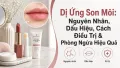 Dị Ứng Son Môi: Nguyên Nhân, Triệu Chứng Và Cách Điều Trị