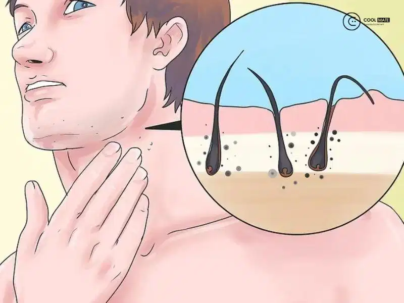 Cơ chế râu mọc ngược dưới da Sợi râu cuộn tròn dưới nang lông gây phản ứng viêm