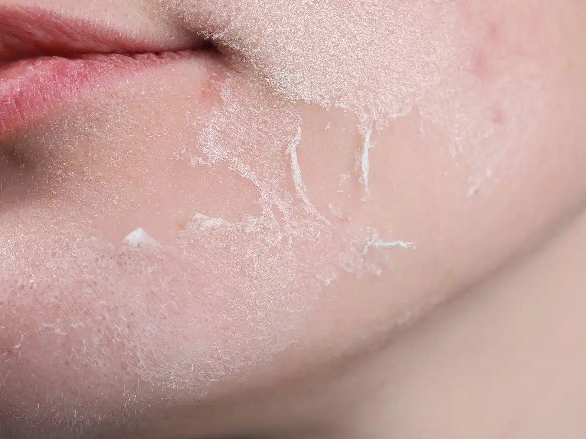 Da khô có thể nứt nẻ vào mùa đông Da khô có thể nứt nẻ vào mùa đông