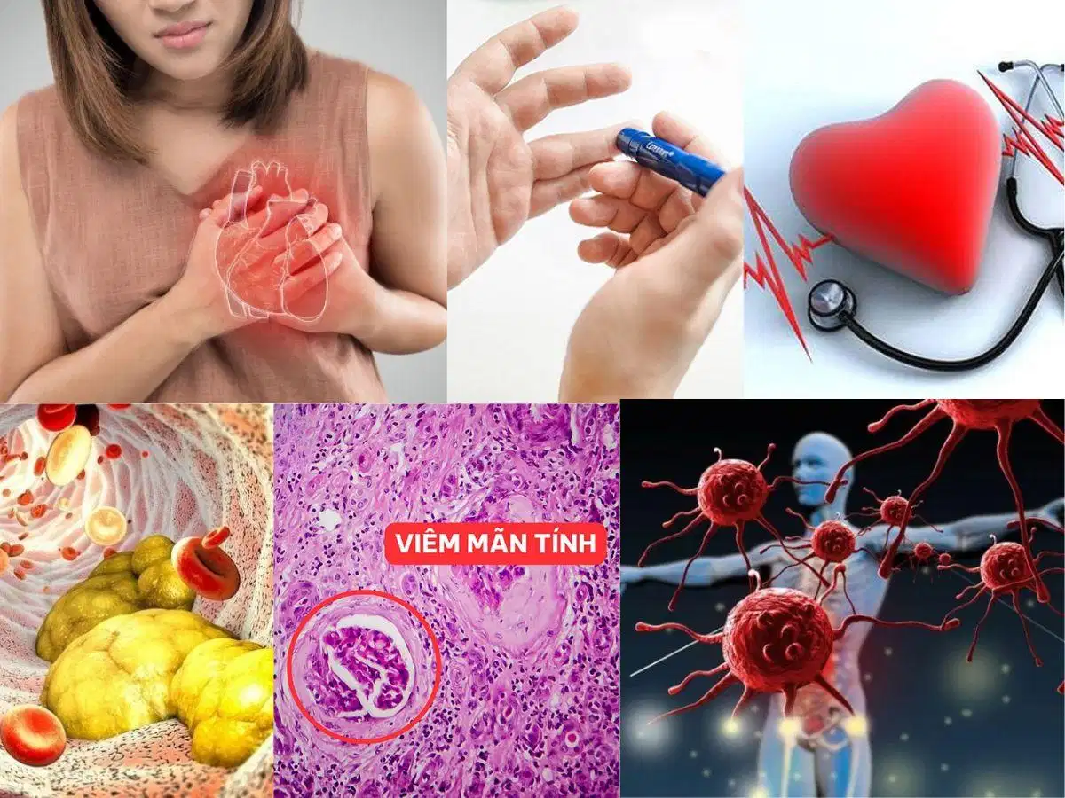 Mỡ bụng dư thừa và rủi ro chuyển hóa Mỡ bụng dư thừa ảnh hưởng đến sức khỏe chuyển hóa và tim mạch