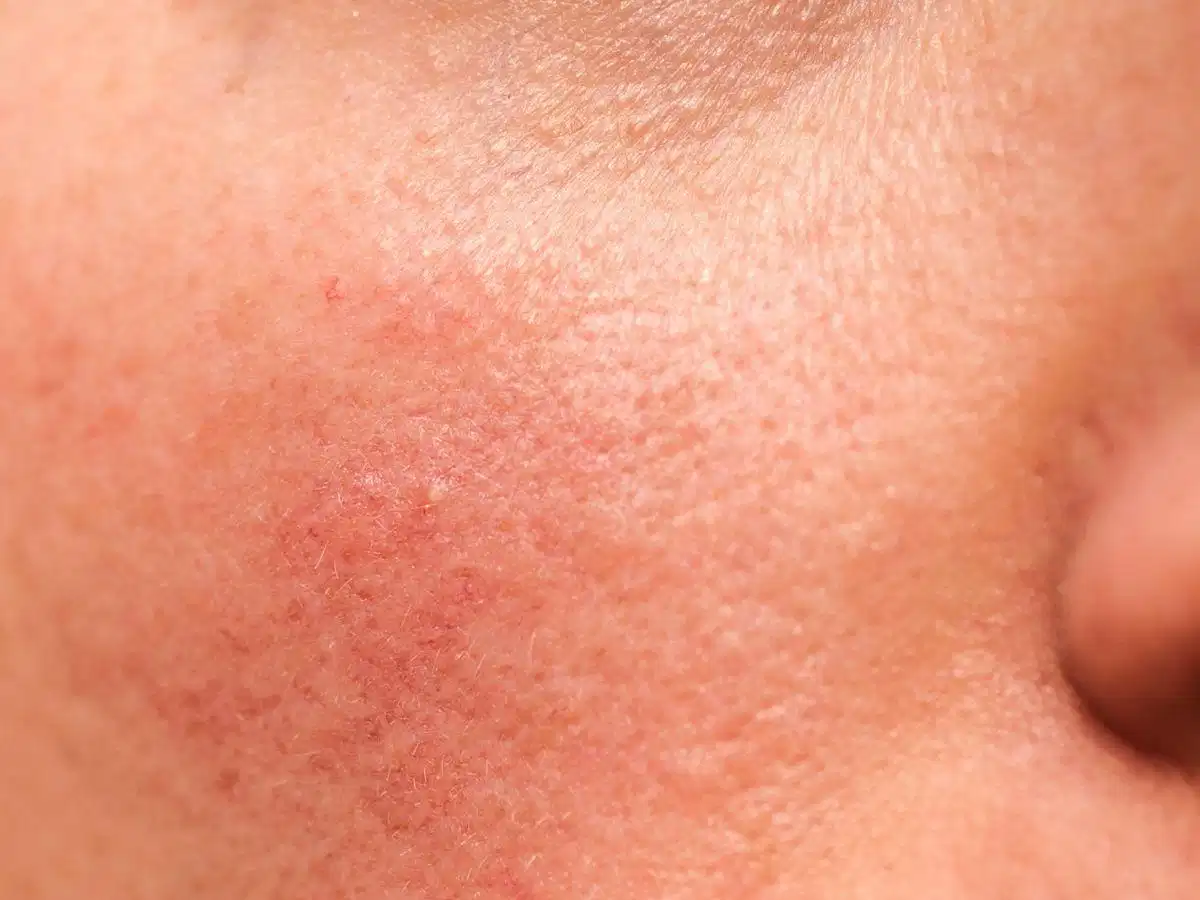 Da nhạy cảm có thể mẩn đỏ khi trời lạnh Da nhạy cảm có thể mẩn đỏ khi trời lạnh