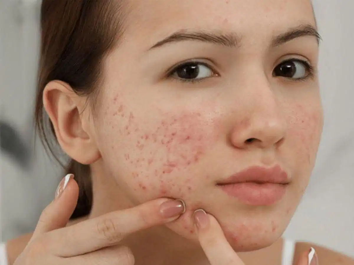 Những việc cần tránh sau khi nặn mụn