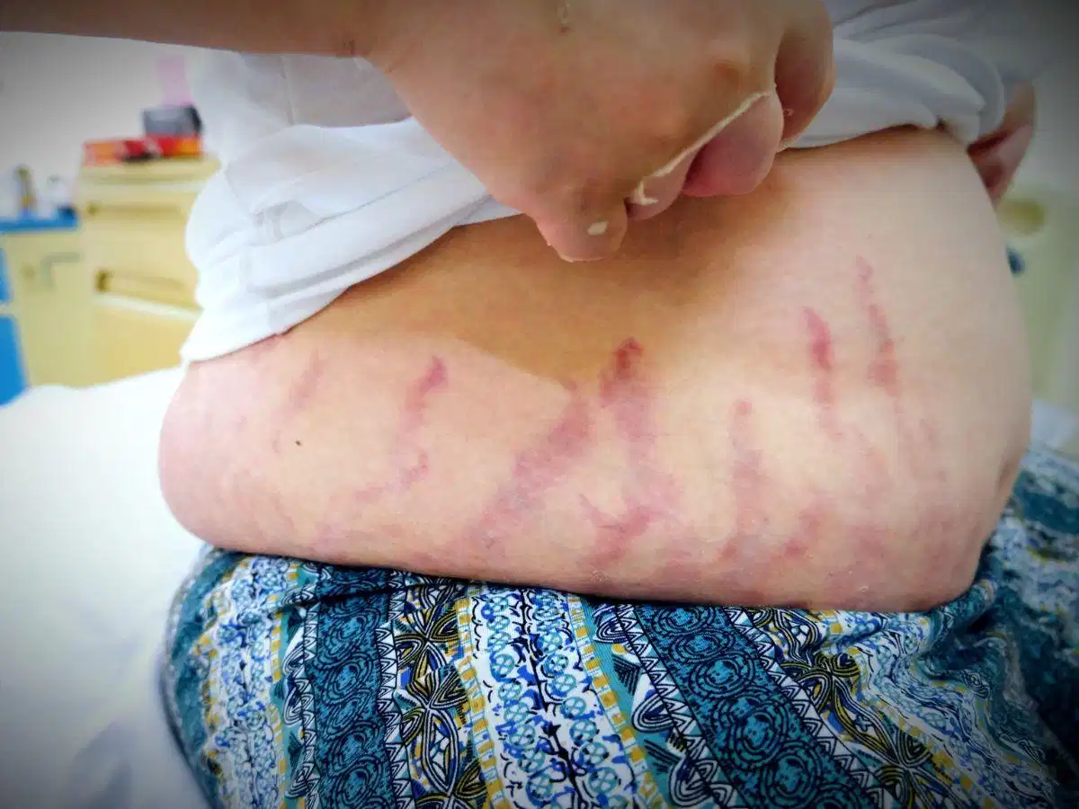 Rạn da do dùng thuốc có steroid Rạn da do tác dụng phụ của thuốc bôi hoặc uống chứa steroid
