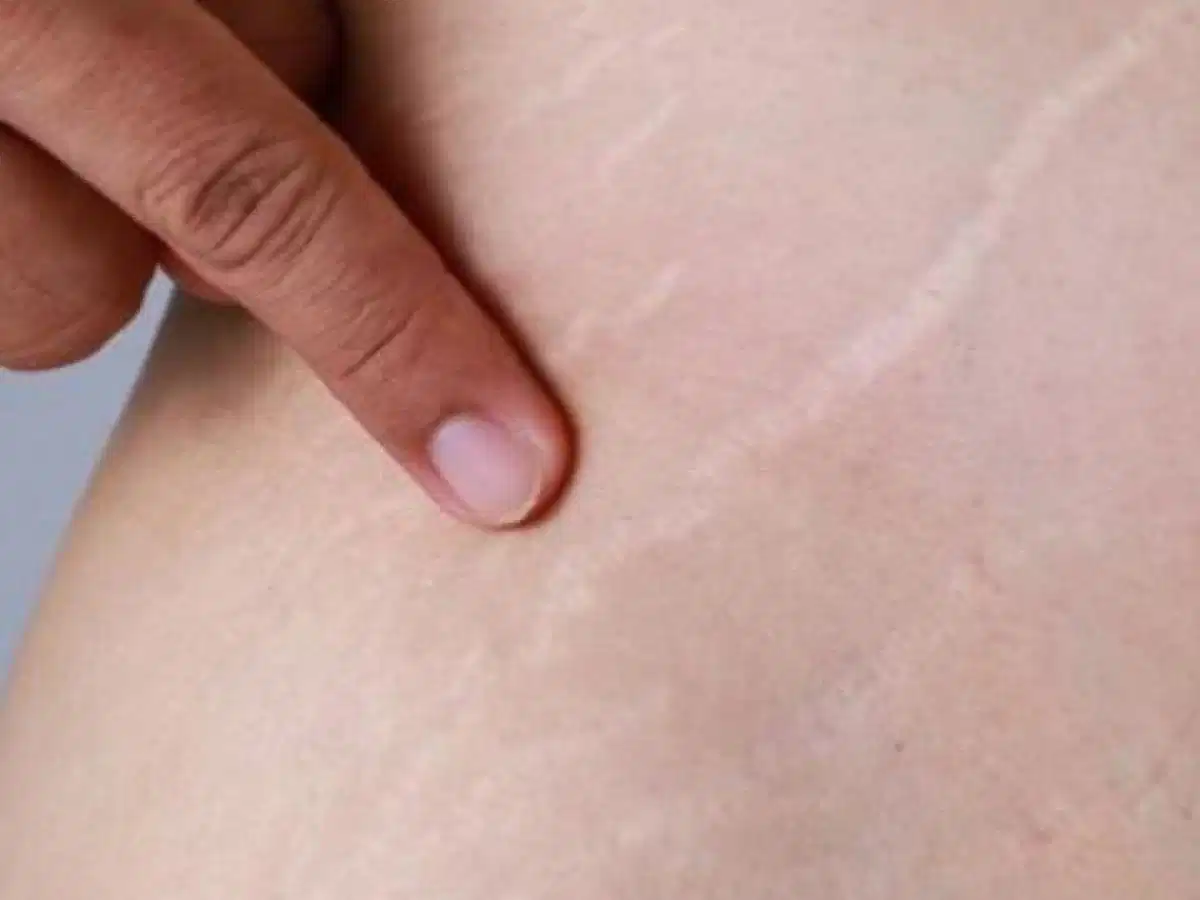 Rạn da do tăng hoặc giảm cân nhanh Rạn da do tăng hoặc giảm cân nhanh chóng ở nam giới